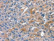 The image on the left is immunohistochemistry of paraffin-embedded Human liver cancer tissue using CSB-PA135946(RNF7 Antibody) at dilution 1/20, on the right is treated with fusion protein. (Original magnification: ×200)