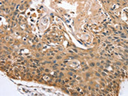 The image on the left is immunohistochemistry of paraffin-embedded Human esophagus cancer tissue using CSB-PA136001(RBM38 Antibody) at dilution 1/45, on the right is treated with synthetic peptide. (Original magnification: ×200)