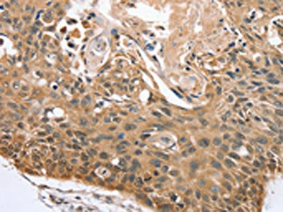 The image on the left is immunohistochemistry of paraffin-embedded Human esophagus cancer tissue using CSB-PA136001(RBM38 Antibody) at dilution 1/45, on the right is treated with synthetic peptide. (Original magnification: ×200)