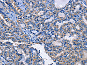 The image on the left is immunohistochemistry of paraffin-embedded Human thyroid cancer tissue using CSB-PA136137(ANXA4 Antibody) at dilution 1/20, on the right is treated with fusion protein. (Original magnification: ×200)