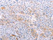 The image on the left is immunohistochemistry of paraffin-embedded Human liver cancer tissue using CSB-PA136242(S1PR4 Antibody) at dilution 1/40, on the right is treated with synthetic peptide. (Original magnification: ×200)