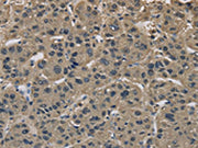 The image on the left is immunohistochemistry of paraffin-embedded Human liver cancer tissue using CSB-PA136380(IMPAD1 Antibody) at dilution 1/20, on the right is treated with synthetic peptide. (Original magnification: ×200)