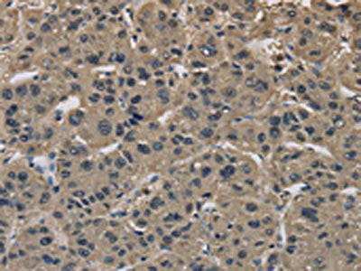 The image on the left is immunohistochemistry of paraffin-embedded Human liver cancer tissue using CSB-PA136380(IMPAD1 Antibody) at dilution 1/20, on the right is treated with synthetic peptide. (Original magnification: ×200)