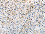 The image on the left is immunohistochemistry of paraffin-embedded Human gastic cancer tissue using CSB-PA136609(NPPC Antibody) at dilution 1/70, on the right is treated with synthetic peptide. (Original magnification: ×200)