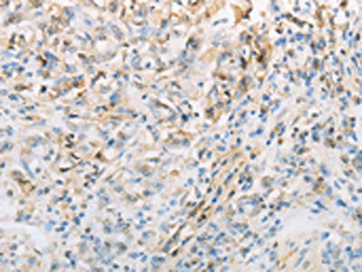The image on the left is immunohistochemistry of paraffin-embedded Human gastic cancer tissue using CSB-PA136609(NPPC Antibody) at dilution 1/70, on the right is treated with synthetic peptide. (Original magnification: ×200)