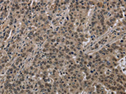 The image on the left is immunohistochemistry of paraffin-embedded Human liver cancer tissue using CSB-PA136772(HIST1H2AH Antibody) at dilution 1/40, on the right is treated with fusion protein. (Original magnification: ×200)