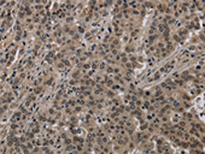 The image on the left is immunohistochemistry of paraffin-embedded Human liver cancer tissue using CSB-PA136772(HIST1H2AH Antibody) at dilution 1/40, on the right is treated with fusion protein. (Original magnification: ×200)
