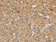 The image on the left is immunohistochemistry of paraffin-embedded Human liver cancer tissue using CSB-PA136864(SLIT2 Antibody) at dilution 1/30, on the right is treated with synthetic peptide. (Original magnification: ×200)
