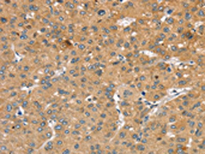 The image on the left is immunohistochemistry of paraffin-embedded Human liver cancer tissue using CSB-PA136864(SLIT2 Antibody) at dilution 1/30, on the right is treated with synthetic peptide. (Original magnification: ×200)