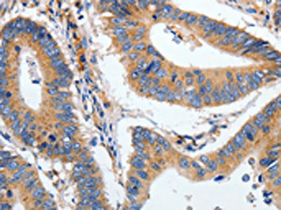 The image on the left is immunohistochemistry of paraffin-embedded Human colon cancer tissue using CSB-PA137102(HSPA1A Antibody) at dilution 1/40, on the right is treated with fusion protein. (Original magnification: ×200)