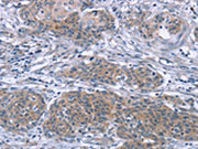 The image on the left is immunohistochemistry of paraffin-embedded Human cervical cancer tissue using CSB-PA137424(PDLIM2 Antibody) at dilution 1/20, on the right is treated with fusion protein. (Original magnification: ×200)