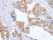 The image on the left is immunohistochemistry of paraffin-embedded Human breast cancer tissue using CSB-PA137436(PTP4A2 Antibody) at dilution 1/30, on the right is treated with synthetic peptide. (Original magnification: ×200)