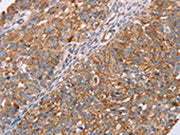 The image on the left is immunohistochemistry of paraffin-embedded Human breast cancer tissue using CSB-PA137479(RMDN3 Antibody) at dilution 1/20, on the right is treated with fusion protein. (Original magnification: ×200)