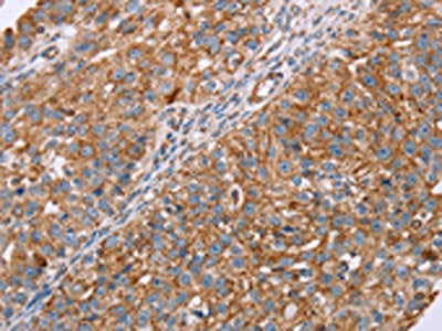 The image on the left is immunohistochemistry of paraffin-embedded Human breast cancer tissue using CSB-PA137479(RMDN3 Antibody) at dilution 1/20, on the right is treated with fusion protein. (Original magnification: ×200)