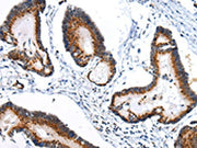 The image on the left is immunohistochemistry of paraffin-embedded Human colorectal cancer tissue using CSB-PA137594(ARFGAP2 Antibody) at dilution 1/25, on the right is treated with synthetic peptide. (Original magnification: ×200)