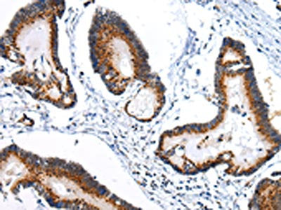 The image on the left is immunohistochemistry of paraffin-embedded Human colorectal cancer tissue using CSB-PA137594(ARFGAP2 Antibody) at dilution 1/25, on the right is treated with synthetic peptide. (Original magnification: ×200)