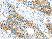 The image on the left is immunohistochemistry of paraffin-embedded Human esophagus cancer tissue using CSB-PA137931(GPR15 Antibody) at dilution 1/20, on the right is treated with synthetic peptide. (Original magnification: ×200)