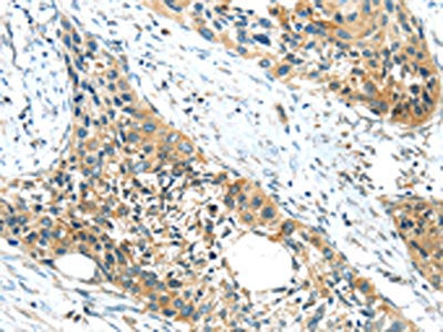 The image on the left is immunohistochemistry of paraffin-embedded Human esophagus cancer tissue using CSB-PA137931(GPR15 Antibody) at dilution 1/20, on the right is treated with synthetic peptide. (Original magnification: ×200)