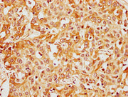 IHC image of CSB-PA13809A0Rb diluted at 1:400 and staining in paraffin-embedded human liver cancer performed on a Leica BondTM system. After dewaxing and hydration, antigen retrieval was mediated by high pressure in a citrate buffer (pH 6.0). Sect...