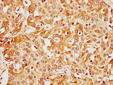 IHC image of CSB-PA13809A0Rb diluted at 1:400 and staining in paraffin-embedded human liver cancer performed on a Leica BondTM system. After dewaxing and hydration, antigen retrieval was mediated by high pressure in a citrate buffer (pH 6.0). Sect...