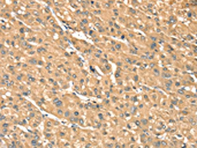 The image on the left is immunohistochemistry of paraffin-embedded Human liver cancer tissue using CSB-PA138167(PHKB Antibody) at dilution 1/25, on the right is treated with fusion protein. (Original magnification: ×200)