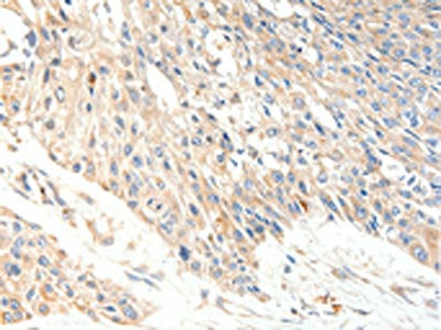 The image on the left is immunohistochemistry of paraffin-embedded Human esophagus cancer tissue using CSB-PA138175(SLC27A1 Antibody) at dilution 1/40, on the right is treated with synthetic peptide. (Original magnification: ×200)