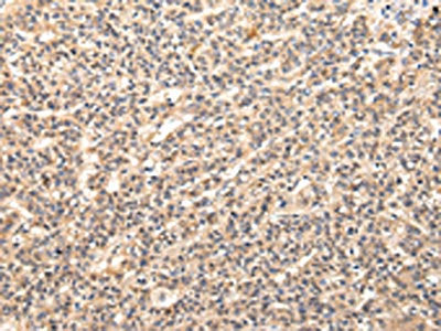 The image on the left is immunohistochemistry of paraffin-embedded Human liver cancer tissue using CSB-PA138216(VPS37D Antibody) at dilution 1/30, on the right is treated with fusion protein. (Original magnification: ×200)