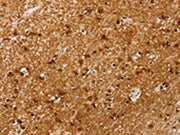 The image on the left is immunohistochemistry of paraffin-embedded Human brain tissue using CSB-PA138264(SSX4 Antibody) at dilution 1/20, on the right is treated with synthetic peptide. (Original magnification: ×200)