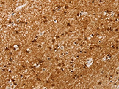 The image on the left is immunohistochemistry of paraffin-embedded Human brain tissue using CSB-PA138264(SSX4 Antibody) at dilution 1/20, on the right is treated with synthetic peptide. (Original magnification: ×200)