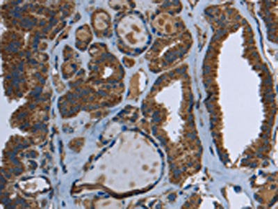 The image on the left is immunohistochemistry of paraffin-embedded Human thyroid cancer tissue using CSB-PA138466(GCK Antibody) at dilution 1/40, on the right is treated with fusion protein. (Original magnification: ×200)
