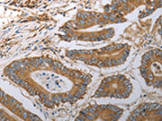 The image on the left is immunohistochemistry of paraffin-embedded Human colon cancer tissue using CSB-PA138621(SLC22A6 Antibody) at dilution 1/40, on the right is treated with synthetic peptide. (Original magnification: ×200)