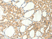 The image on the left is immunohistochemistry of paraffin-embedded Human thyroid cancer tissue using CSB-PA138687(TRPM5 Antibody) at dilution 1/60, on the right is treated with synthetic peptide. (Original magnification: ×200)