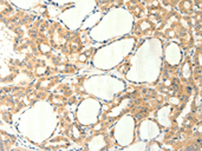 The image on the left is immunohistochemistry of paraffin-embedded Human thyroid cancer tissue using CSB-PA138687(TRPM5 Antibody) at dilution 1/60, on the right is treated with synthetic peptide. (Original magnification: ×200)