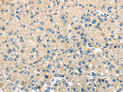 The image on the left is immunohistochemistry of paraffin-embedded Human liver cancer tissue using CSB-PA138752(TMPRSS11A Antibody) at dilution 1/30, on the right is treated with fusion protein. (Original magnification: ×200)