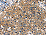 The image on the left is immunohistochemistry of paraffin-embedded Human breast cancer tissue using CSB-PA138826(TBX10 Antibody) at dilution 1/30, on the right is treated with fusion protein. (Original magnification: ×200)