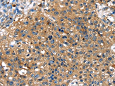 The image on the left is immunohistochemistry of paraffin-embedded Human breast cancer tissue using CSB-PA138826(TBX10 Antibody) at dilution 1/30, on the right is treated with fusion protein. (Original magnification: ×200)