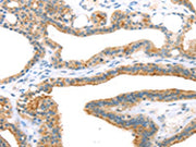 The image on the left is immunohistochemistry of paraffin-embedded Human thyroid cancer tissue using CSB-PA138859(TNIP2 Antibody) at dilution 1/35, on the right is treated with synthetic peptide. (Original magnification: ×200)
