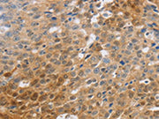 The image on the left is immunohistochemistry of paraffin-embedded Human ovarian cancer tissue using CSB-PA138945(SLC16A7 Antibody) at dilution 1/70, on the right is treated with synthetic peptide. (Original magnification: ×200)
