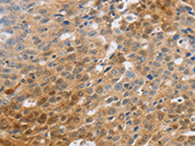 The image on the left is immunohistochemistry of paraffin-embedded Human ovarian cancer tissue using CSB-PA138945(SLC16A7 Antibody) at dilution 1/70, on the right is treated with synthetic peptide. (Original magnification: ×200)