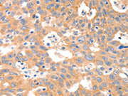The image on the left is immunohistochemistry of paraffin-embedded Human ovarian cancer tissue using CSB-PA139014(P2RY11 Antibody) at dilution 1/30, on the right is treated with synthetic peptide. (Original magnification: ×200)