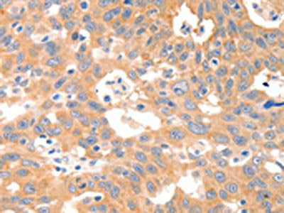 The image on the left is immunohistochemistry of paraffin-embedded Human ovarian cancer tissue using CSB-PA139014(P2RY11 Antibody) at dilution 1/30, on the right is treated with synthetic peptide. (Original magnification: ×200)