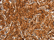 The image on the left is immunohistochemistry of paraffin-embedded Human gastic cancer tissue using CSB-PA139203(PRKD1 Antibody) at dilution 1/15, on the right is treated with synthetic peptide. (Original magnification: ×200)