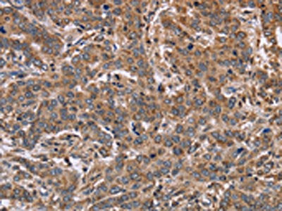 The image on the left is immunohistochemistry of paraffin-embedded Human liver cancer tissue using CSB-PA139252(FAAH2 Antibody) at dilution 1/30, on the right is treated with fusion protein. (Original magnification: ×200)