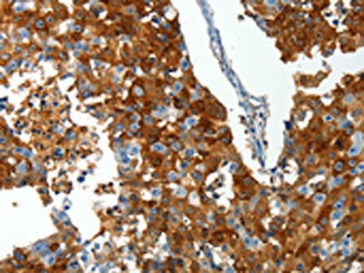 The image on the left is immunohistochemistry of paraffin-embedded Human breast cancer tissue using CSB-PA139278(ABCG1 Antibody) at dilution 1/25, on the right is treated with synthetic peptide. (Original magnification: ×200)