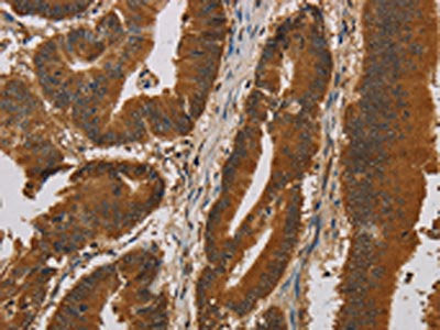 The image on the left is immunohistochemistry of paraffin-embedded Human colon cancer tissue using CSB-PA139485(IPO9 Antibody) at dilution 1/20, on the right is treated with synthetic peptide. (Original magnification: ×200)