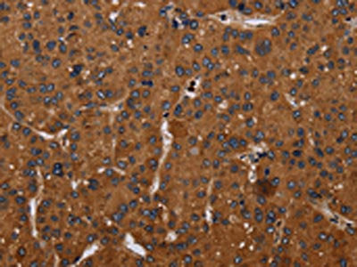 The image on the left is immunohistochemistry of paraffin-embedded Human liver cancer tissue using CSB-PA140004(CYBB Antibody) at dilution 1/50, on the right is treated with synthetic peptide. (Original magnification: ×200)