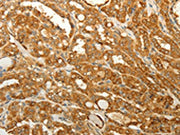 The image on the left is immunohistochemistry of paraffin-embedded Human thyroid cancer tissue using CSB-PA140113(RAB35 Antibody) at dilution 1/50, on the right is treated with synthetic peptide. (Original magnification: ×200)