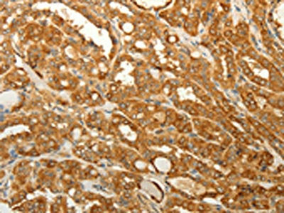 The image on the left is immunohistochemistry of paraffin-embedded Human thyroid cancer tissue using CSB-PA140113(RAB35 Antibody) at dilution 1/50, on the right is treated with synthetic peptide. (Original magnification: ×200)