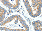 The image on the left is immunohistochemistry of paraffin-embedded Human colon cancer tissue using CSB-PA140509(NTRK1 Antibody) at dilution 1/30, on the right is treated with synthetic peptide. (Original magnification: ×200)