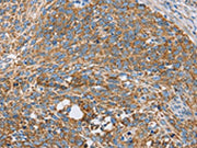The image on the left is immunohistochemistry of paraffin-embedded Human cervical cancer tissue using CSB-PA140740(CENPO Antibody) at dilution 1/40, on the right is treated with fusion protein. (Original magnification: ×200)